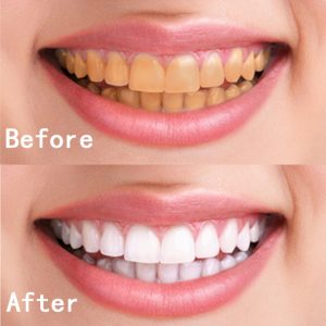 teeth whitening cost in ahmedabad