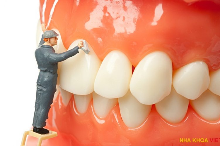 Dental Scaling & Its Benefit