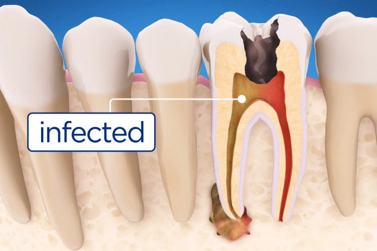 Root Canal Treatment: Everything You Need to know
